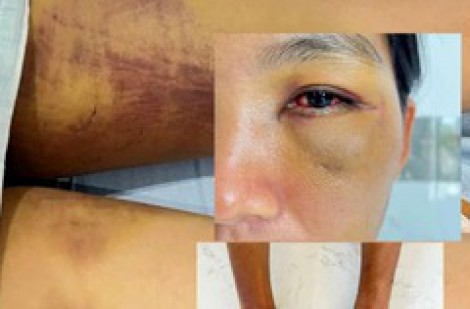 Bình Thuận: Bắt giam các bị can tra tấn em dâu để 'trừ tà'