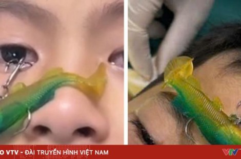 Cứu bé trai bị móc câu cá đâm xuyên nhãn cầu