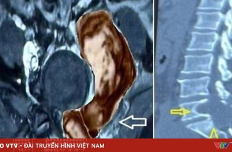 Khối u quái ác quay lại sau thời gian dài “ngủ yên”