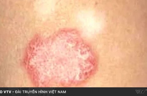 Lupus ban đỏ – Căn bệnh tự miễn thầm lặng và nguy hiểm