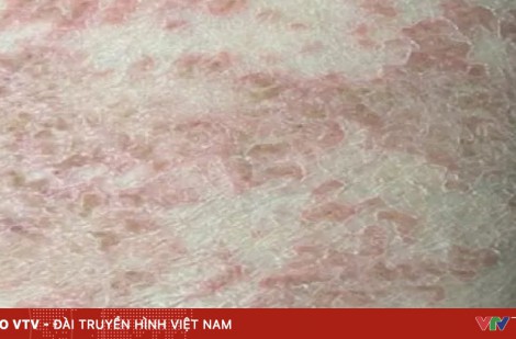 Mắc 6 loại giun, sán từ những thói quen phổ biến