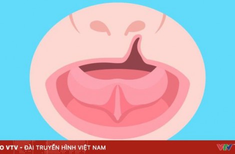 Mang nụ cười trọn vẹn cho bệnh nhân sứt môi, hở hàm ếch