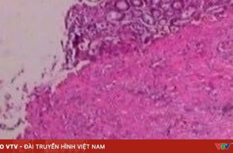 Nấm – kẻ giấu mặt nguy hiểm trong cơ thể người bệnh