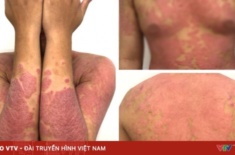 Tạm biệt vảy nến nhờ thuốc sinh học