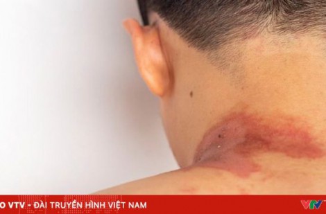 Thoát sốc phản vệ sau khi bị kiến ba khoang cắn