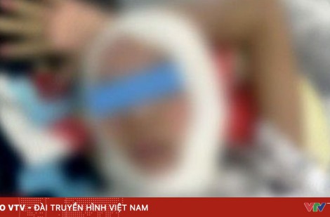 Trẻ bỏng nặng do đốt cồn với lúa làm cốm nổ