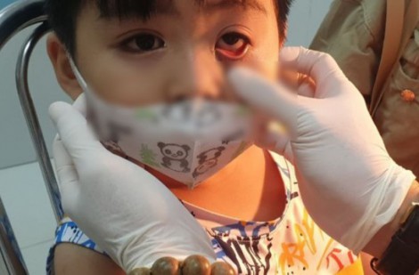 Trẻ mầm non đi học giữa mùa dịch đau mắt đỏ: Bác sĩ khuyên những việc cần làm để phòng bệnh