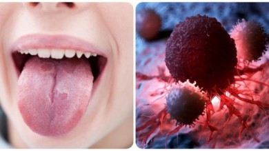 Vết loét trong miệng tưởng chừng bệnh thông thường nhưng lại có thể là dấu hiệu ung thư