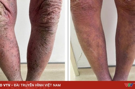 Viêm da cơ địa nặng do tự mua thuốc bôi, uống không rõ nguồn gốc