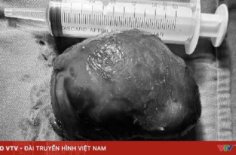 Ẩn tinh hoàn trong ổ bụng: Một trường hợp ung thư hoá hiếm gặp