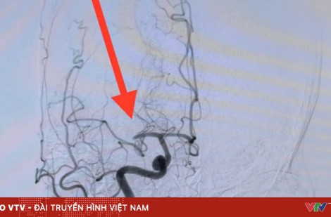 Đột quỵ não – cần nhận biết sớm tránh biến chứng nguy hiểm